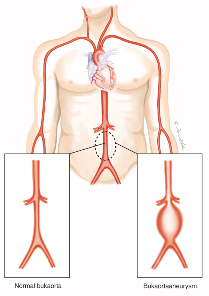 bukaorta, bukaorta aneurysm