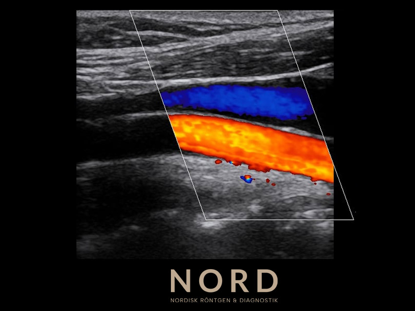 ultraljud dvt, ultraljud blodpropp, ultraljud benvener propp utan remiss
