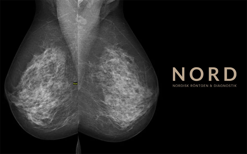 mammografi privat, privat mammografi, mammografi privat pris, mammografi väntetid, mammografi stockholm